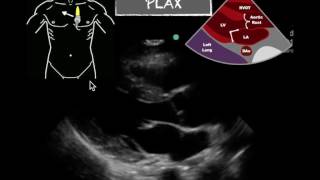 POCUS PLAX Normal EF [upl. by Atiuqehc]