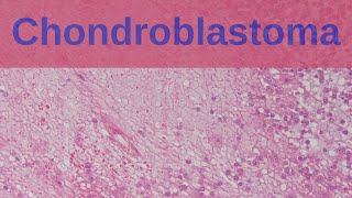 Chondroblastoma  Pathology mini tutorial [upl. by Boudreaux]