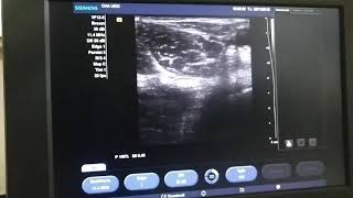 Ultrasound amp PNS guided obturator nerve block [upl. by Wohlen]