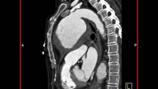 MDCT 64 Aortic Aneurysm Sagittal View [upl. by Illac]