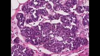 Histopathology Breast Lobular carcinoma in situ [upl. by Cami]