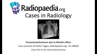 Pneumomediastinum due to Macklin effect Radiopaediaorg Cases in Radiology [upl. by Eceer]