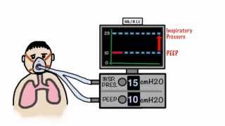 CPAP and NonInvasive Ventilation in 5 minutes [upl. by Gadmon967]