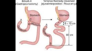 surgery post gastrectomy syndromes د عامر الخزاعي [upl. by Akenom]