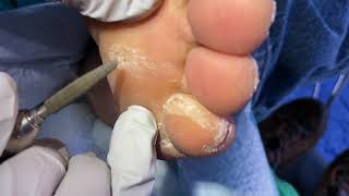 June clinic toenails calluses and corns continue [upl. by Karim85]