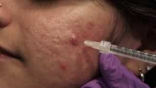 Watch amp Learn Intralesional injections [upl. by Dougald]