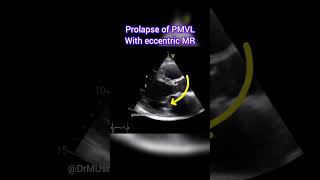 Prolapse of Posterior Mitral Valve Leaflet with Eccentric MR echocardiogram echocardiography [upl. by Terzas]