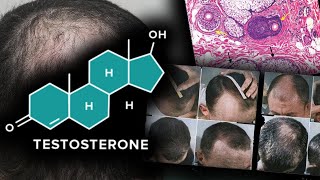 Testosterone Doesnt Grow Scalp Hair [upl. by Ordway]