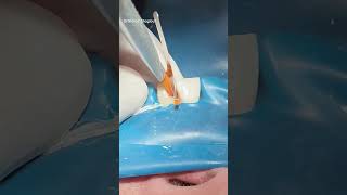 Root canal treatment amp composite restoration dentist [upl. by Eninej]