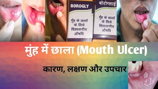 Boroglycerine Ointment  Mouth paint  मुंह के छालों के लिए अच्छी दवा  मुंह में छाले होने का कारण [upl. by Gregory98]