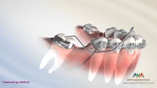 Orthodontic Treatment for Molar Uprighting  Cantilever Spring [upl. by Ardnaxila]