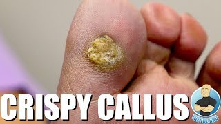 Crazy HARD SKIN CALLUS Foot Scraping PART 1 [upl. by Fablan]