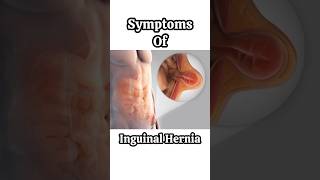 Inguinal hernia symptoms I Hernia treatment in Delhi [upl. by Neile946]