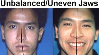 Orthodontic Treatment of Asymmetrical Unbalanced Disproportionate or Unequal Jaw by Dr Mike Mew [upl. by Williams963]