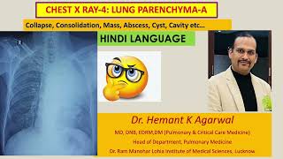 Radiology Chest X Ray4 HINDI Collapse Consolidation Mass AbscessDr Hemant K Agarwal [upl. by Nytsuj539]