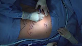 Technique for Chest Tube Insertion [upl. by Adlemy53]