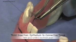 How to Suture Internal Mattress Suture [upl. by Yesnnyl]