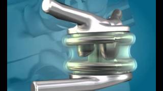 TOPS System for Treatment of Spinal Stenosis [upl. by Anayhd966]