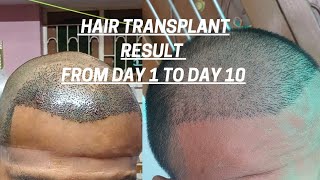 Hair transplant result from Day 1 to Day 10 [upl. by Maiga]