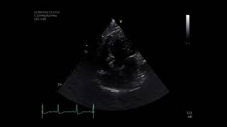 pulmonary stenosis [upl. by Nyleuqaj]