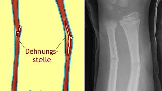 Grünholzfraktur Ursachen Diagnose und Behandlung [upl. by Eugeniusz250]