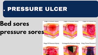 What is Pressure ulcer Bedsores in HindiUrdu [upl. by Sussna]