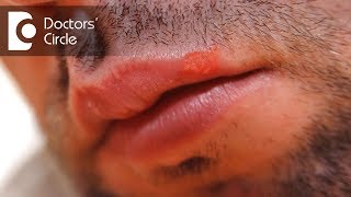 What can cause a lip blister and its management  Dr Sachith Abraham [upl. by Nytram]