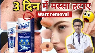 Wart Remover creamwart remover ointment meesho instant Blemish Removalमस्सा कैसे हटाए in 2023 [upl. by Stillman]