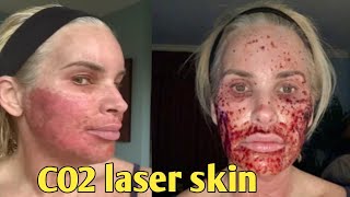 7Day Journey My CO2 Laser Skin Resurfacing Experience – Before and after chris link [upl. by Mcilroy]