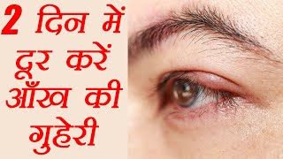 आंख की गुहेरी दूर करने के घरेलु उपाय  How to get rid of a Stye  Eye Care  Hordeolum  Boldsky [upl. by Jit176]