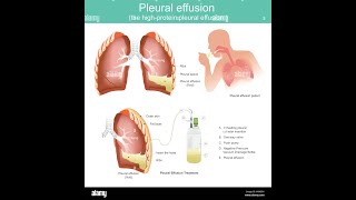 🤩 CAT devant un épanchement pleural 🤩 liquidien explication la plus claire Dr Benzadi [upl. by Cired]