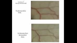 Video Brimonidine Causes Rapid Increase in Pulsatile Aqueous Outflow [upl. by Harold]