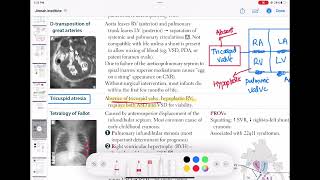 Tricuspid Atresia congenitalheartdisease cardiology 55 First Aid USMLE Step 1 in UrduHindi [upl. by Shultz]