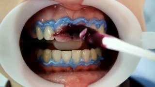 Using FGM Whiteness HP Maxx For In Office Bleaching Tooth Whitening [upl. by Ushijima55]