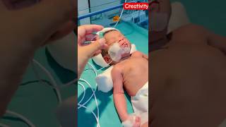 Newborn baby orogastric Tube Feeding video nicu medical viral [upl. by Karilla898]