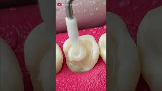 Unbelievable Tooth Restoration asmr restoration [upl. by So]