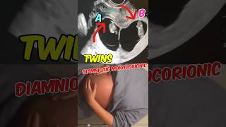 Double joy Twins ultrasound  Diamniotic Monochorionic  Girls pregnancy babyshorts [upl. by Dragelin370]