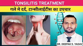 TONSILITIS CAUSES SINGS amp SYMPTOMS TREATMENT tonsillitis treatmentoftonsilitis [upl. by Rosenblast]