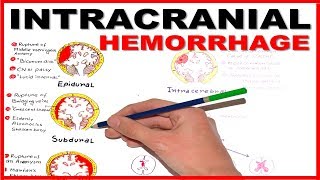 Intracranial Hemorrhage EpiduralSubduralSubarachnoid overview [upl. by Gudrin]