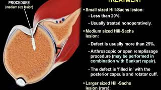 Shoulder Dislocation amp Hill Sachs Injury  Everything You Need To Know  Dr Nabil Ebraheim [upl. by Eile]