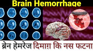 Brain hemorrhageICH Intracranial hemorrhagesymptomscausesManagement ब्रेन हेमरेज क्या होता है [upl. by Derrek771]