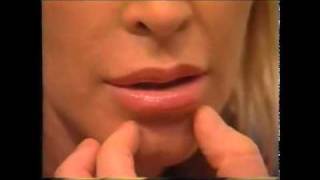 Dr Randal Haworth  Lip Enhancement via VY Plasty [upl. by Mehta]