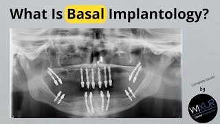 What Is Basal Implantology A Comparison To Classic Implants [upl. by Reynolds]