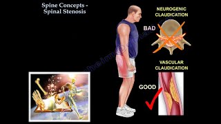 Spinal Stenosis  Everything You Need To Know  Dr Nabil Ebraheim [upl. by Ringe]