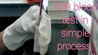 ESR Blood test in simple process [upl. by Hanyaz]