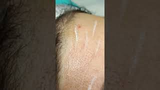 Lifting de frente con Plasma Pen Fibroblast [upl. by Ruthi]