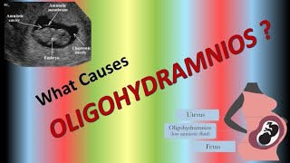 What Causes Oligohydramnios in Pregnancy  What can cause amniotic fluid levels to be low [upl. by Namhar]