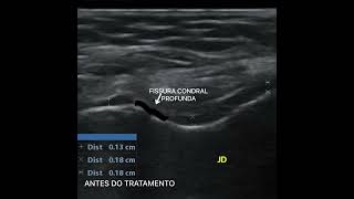 Regeneração de Cartilagem em Joelho  Método TIRT Terapia Indutora de Regeneração Tecidual [upl. by Odarbil]