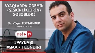 AYAQLARA QULLUQ  ÖDEMİN SEBEBLERİ  ŞİŞKİNLİKLƏR Dr Vuqar FETTAHPUR CərrahFleboloq MEDPLUS [upl. by Jc]