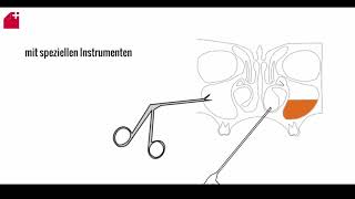 Nasennebenhöhlen OP  FESS  chronische Sinusitis [upl. by Natloz230]